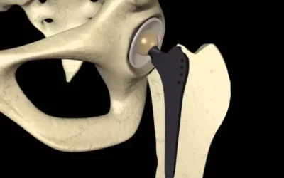 Coxartrosi