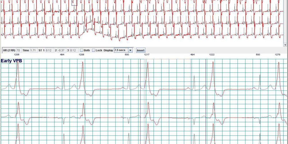 Holter