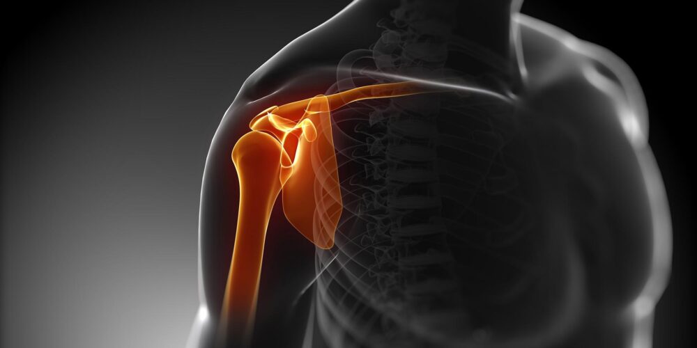 Sindrome da Impingement