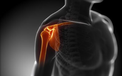Sindrome da Impingement