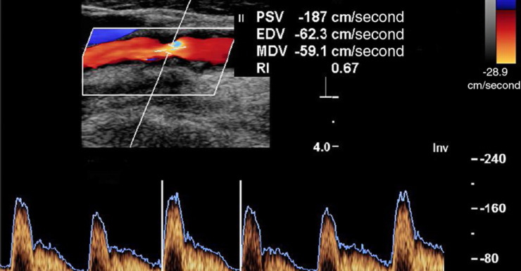 Ecodoppler TSA